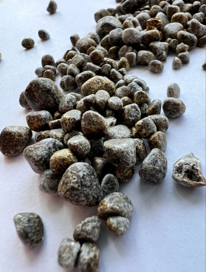 В Балакове врачи извлекли у пенсионера более 400 камней из желчного пузыря