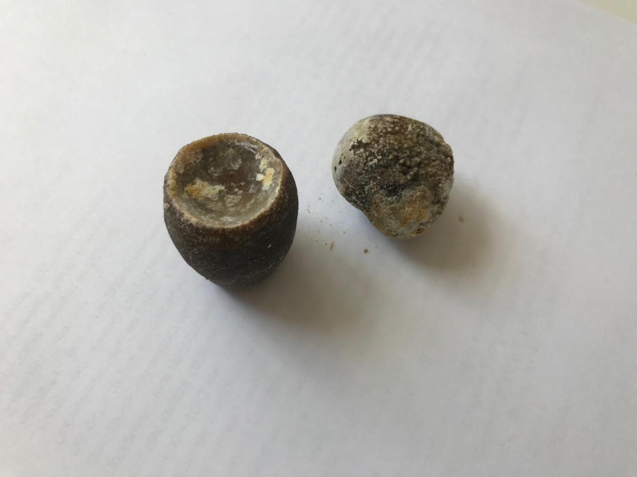 В Балакове врачи извлекли у пенсионера более 400 камней из желчного пузыря