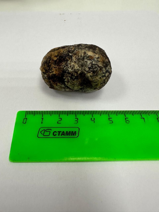 В Балакове врачи извлекли у пенсионера более 400 камней из желчного пузыря