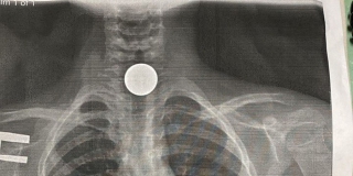 Под Саратовом 9-летний мальчик наглотался 5-рублевых монет Под Саратовом 9-летний мальчик наглотался 5-рублевых монет