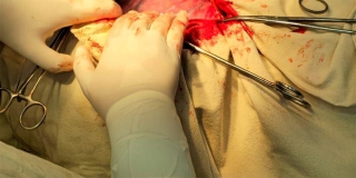 В Энгельсе врачи удалили пациентке 17-килограммовую опухоль В Энгельсе врачи удалили пациентке 17-килограммовую опухоль