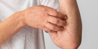 Ситуацию с ветрянкой в Саратовской области назвали стабильной Ситуацию с ветрянкой в Саратовской области назвали стабильной