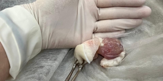 В Балакове медики спасли мужчину с застрявшим в горле куском сала В Балакове медики спасли мужчину с застрявшим в горле куском сала